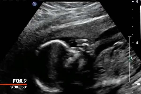 Baby Noah Ultrasound