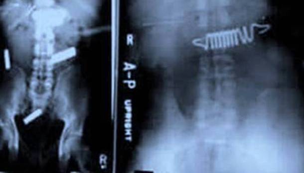 Bedsprings and Batteries In Stomach X-Ray