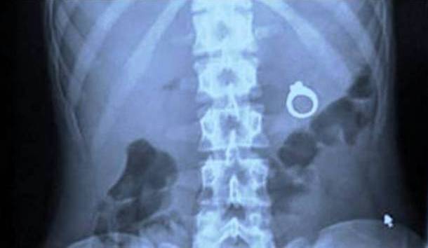 Engagement Ring In Stomach X-Ray