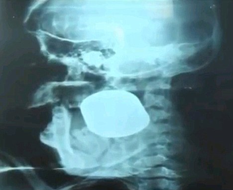 Grenade In Skull X-Ray