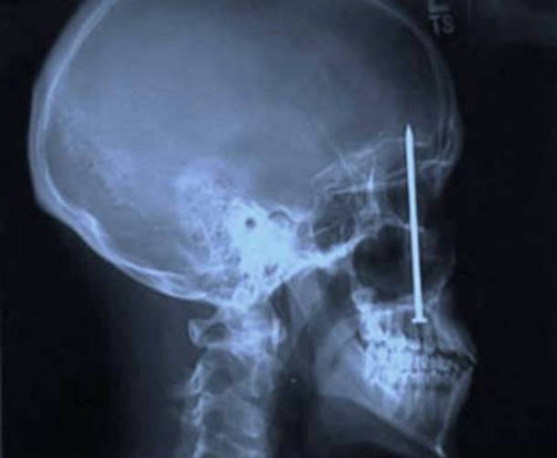 Nail In Brain X-Ray