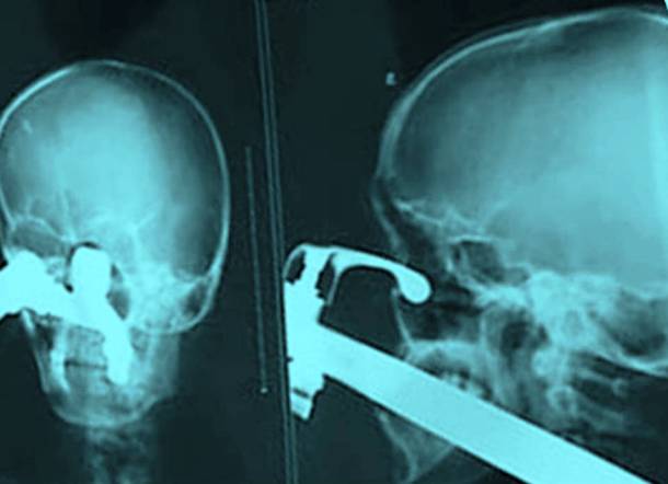 Tap Through The Head X-Ray