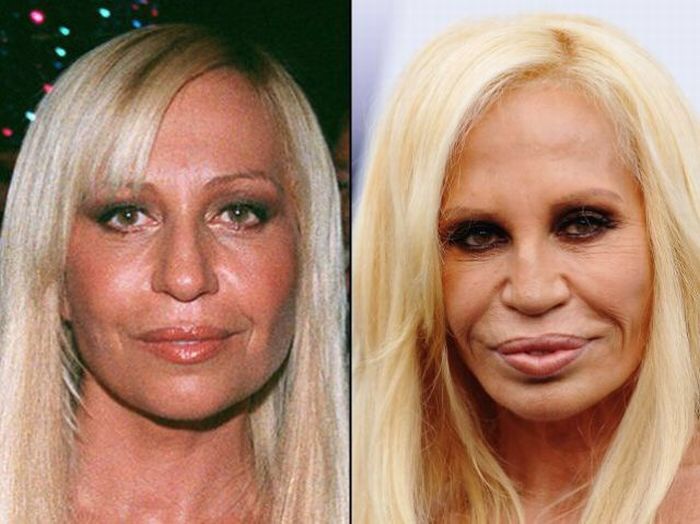 Donatello Versace Before And After Plastic Surgery