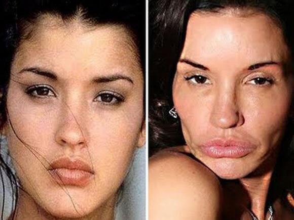 Janice Dickinson Before And After Plastic Surgery