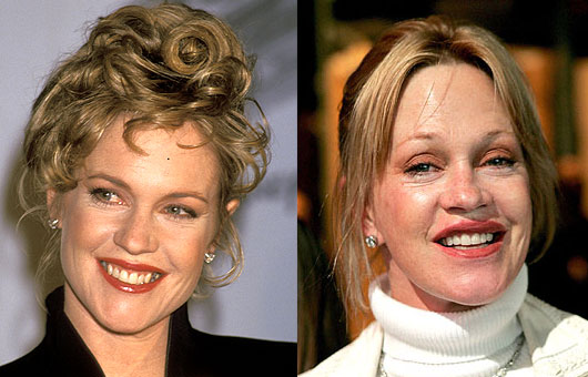 Melanie Griffith Before And After Plastic Surgery