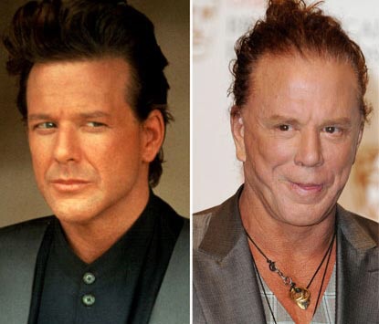 Mickey Rourke Before And After Plastic Surgery