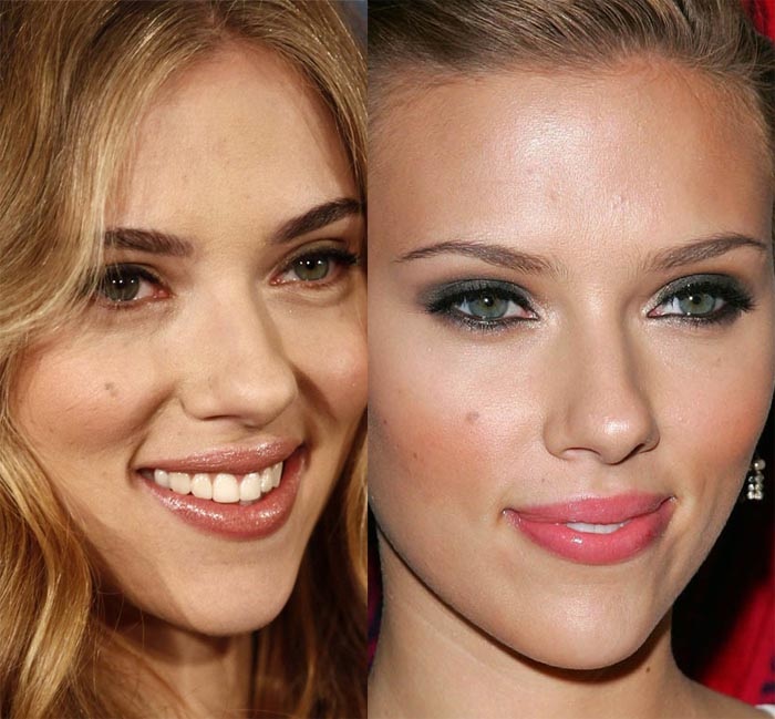 Scarlett Johansson Before And After Plastic Surgery