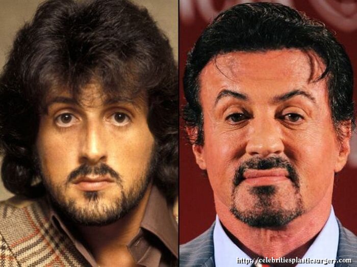 Sylvester Stallone Before And After Plastic Surgery